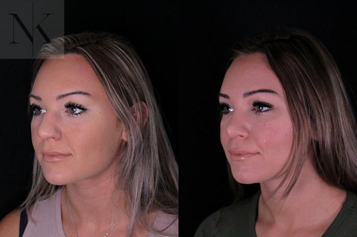 Before & After Rhinoplasty Case 206 Left Oblique View in Wethersfield, Hartford, Nebraska
