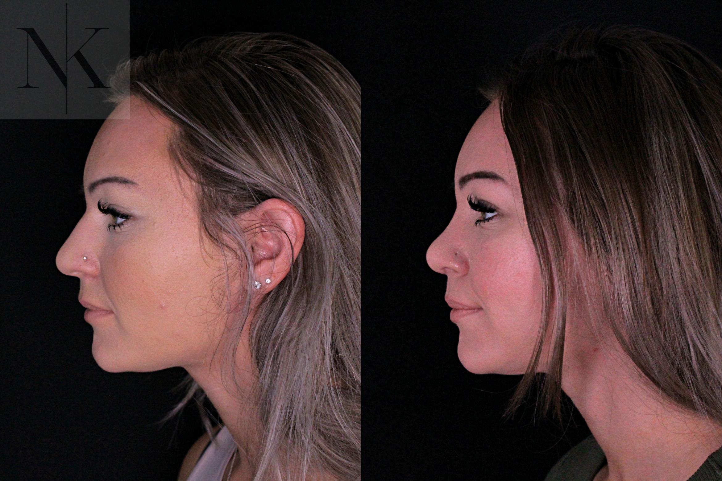 Before & After Rhinoplasty Case 206 Left Side View in Wethersfield, Hartford, Nebraska
