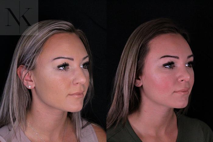 Before & After Rhinoplasty Case 206 Right Oblique View in Wethersfield, Hartford, Nebraska