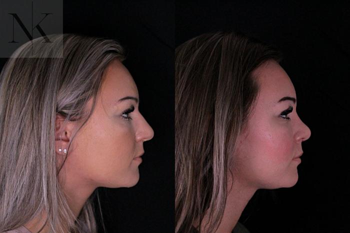 Before & After Rhinoplasty Case 206 Right Side View in Wethersfield, Hartford, Nebraska