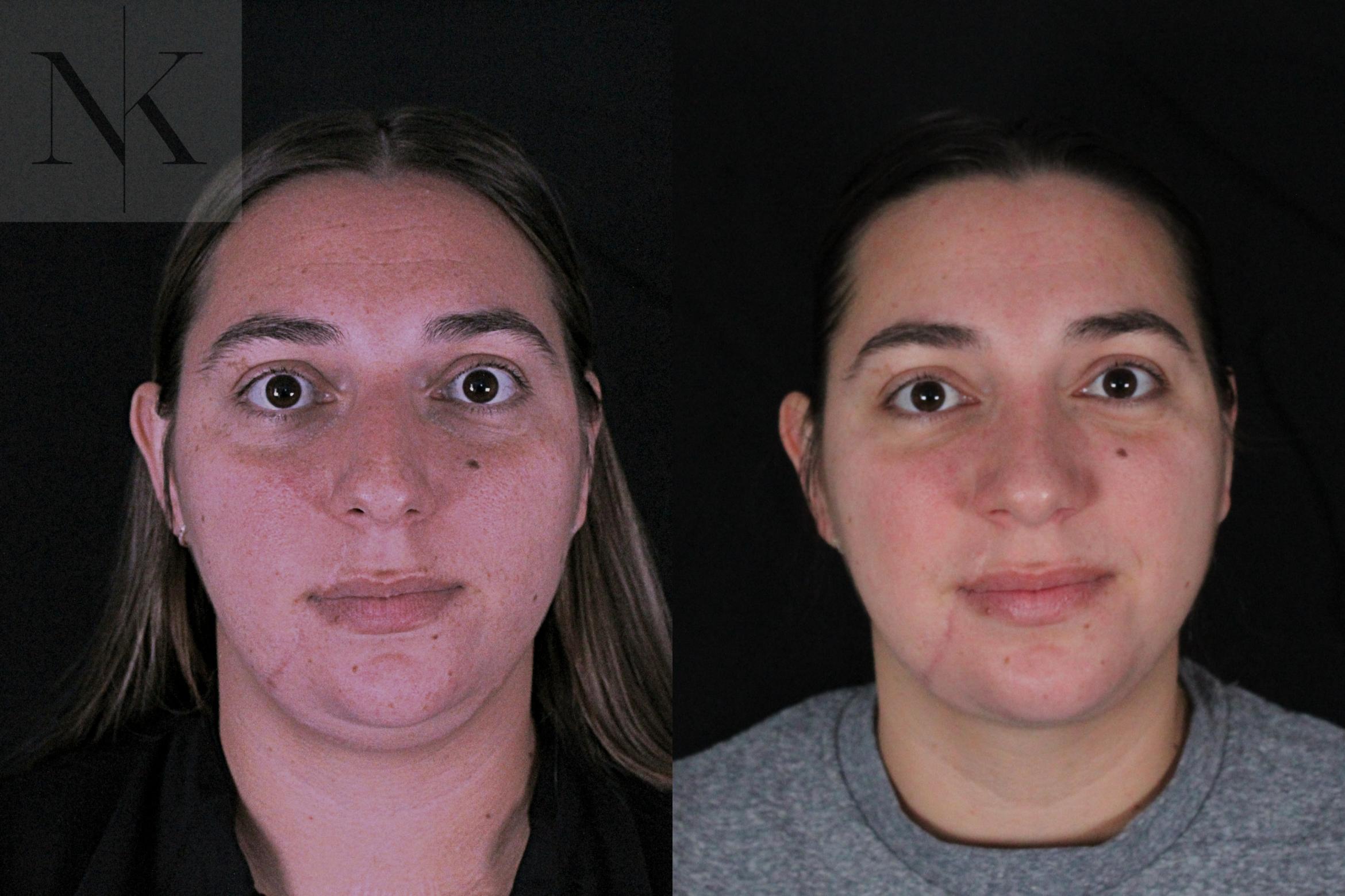 Before & After Deep Neck Sculpting Case 207 Front View in Wethersfield, Hartford, Nebraska