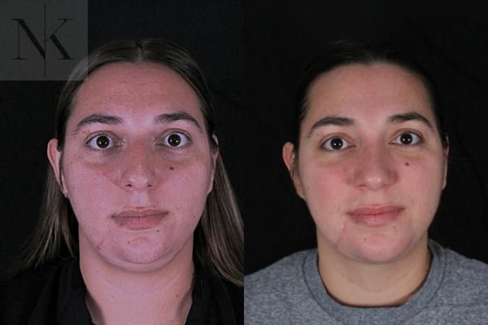 Before & After Deep Neck Sculpting Case 207 Front View in Wethersfield, Hartford, Nebraska