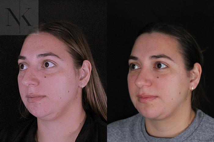 Before & After Deep Neck Sculpting Case 207 Left Oblique View in Wethersfield, Hartford, Nebraska