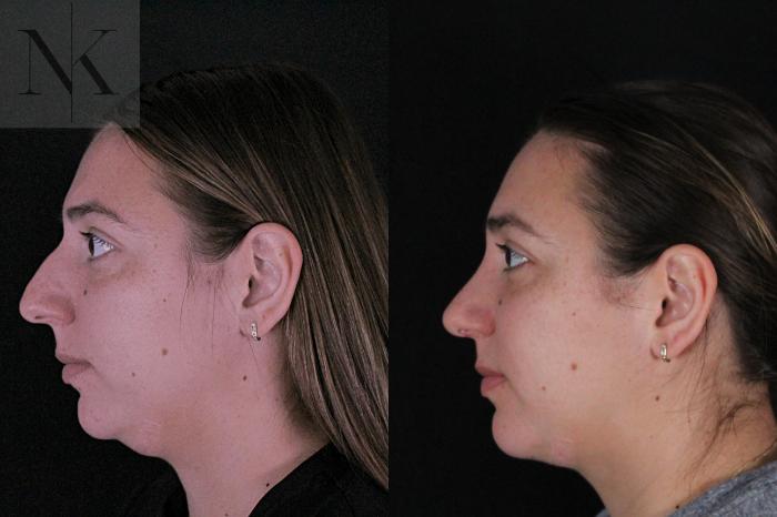 Before & After Deep Neck Sculpting Case 207 Left Side View in Wethersfield, Hartford, Nebraska