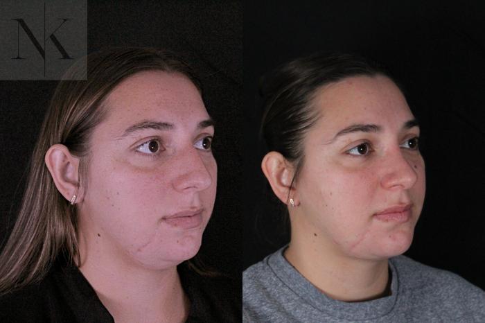 Before & After Deep Neck Sculpting Case 207 Right Oblique View in Wethersfield, Hartford, Nebraska