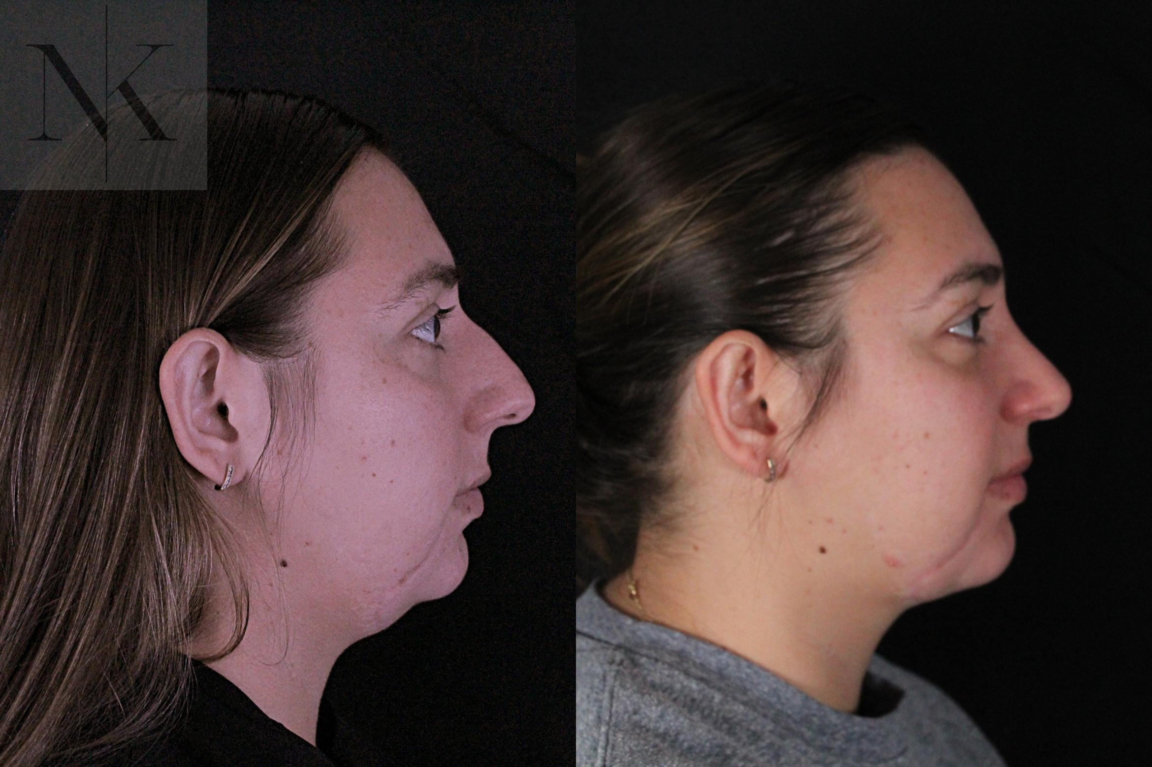Before & After Deep Neck Sculpting Case 207 Right Side View in Wethersfield, Hartford, Nebraska