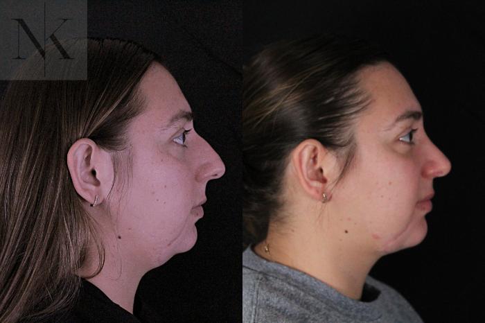 Before & After Deep Neck Sculpting Case 207 Right Side View in Wethersfield, Hartford, Nebraska