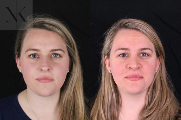 Before & After Rhinoplasty Case 209 Front View in Wethersfield, Hartford, Nebraska