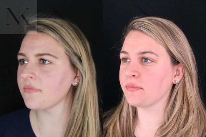 Before & After Rhinoplasty Case 209 Left Oblique View in Wethersfield, Hartford, Nebraska
