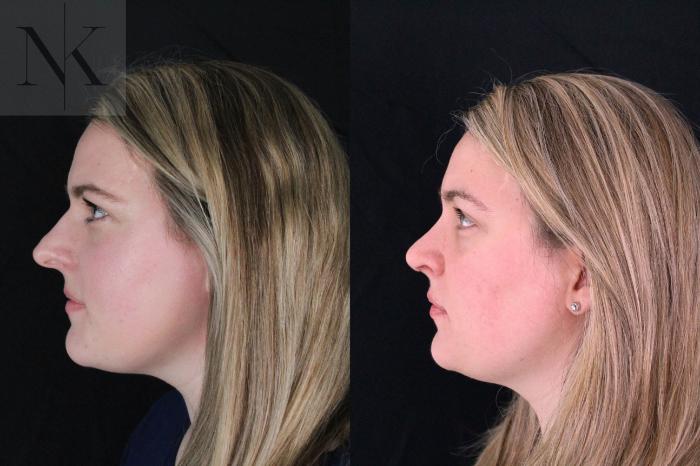Before & After Rhinoplasty Case 209 Left Side View in Wethersfield, Hartford, Nebraska