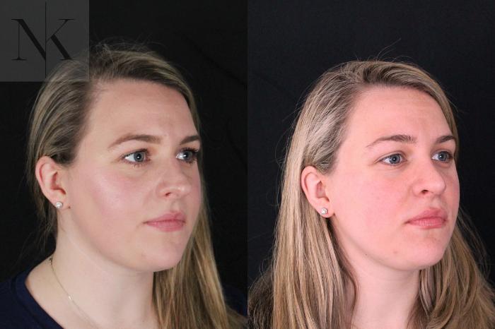 Before & After Rhinoplasty Case 209 Right Oblique View in Wethersfield, Hartford, Nebraska