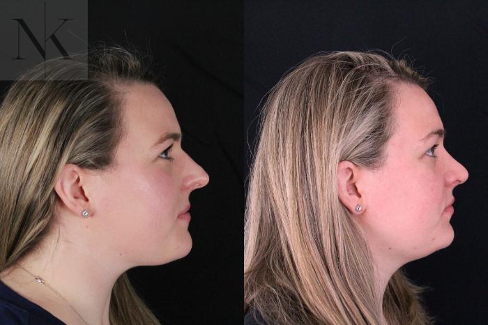 Before & After Rhinoplasty Case 209 Right Side View in Wethersfield, Hartford, Nebraska