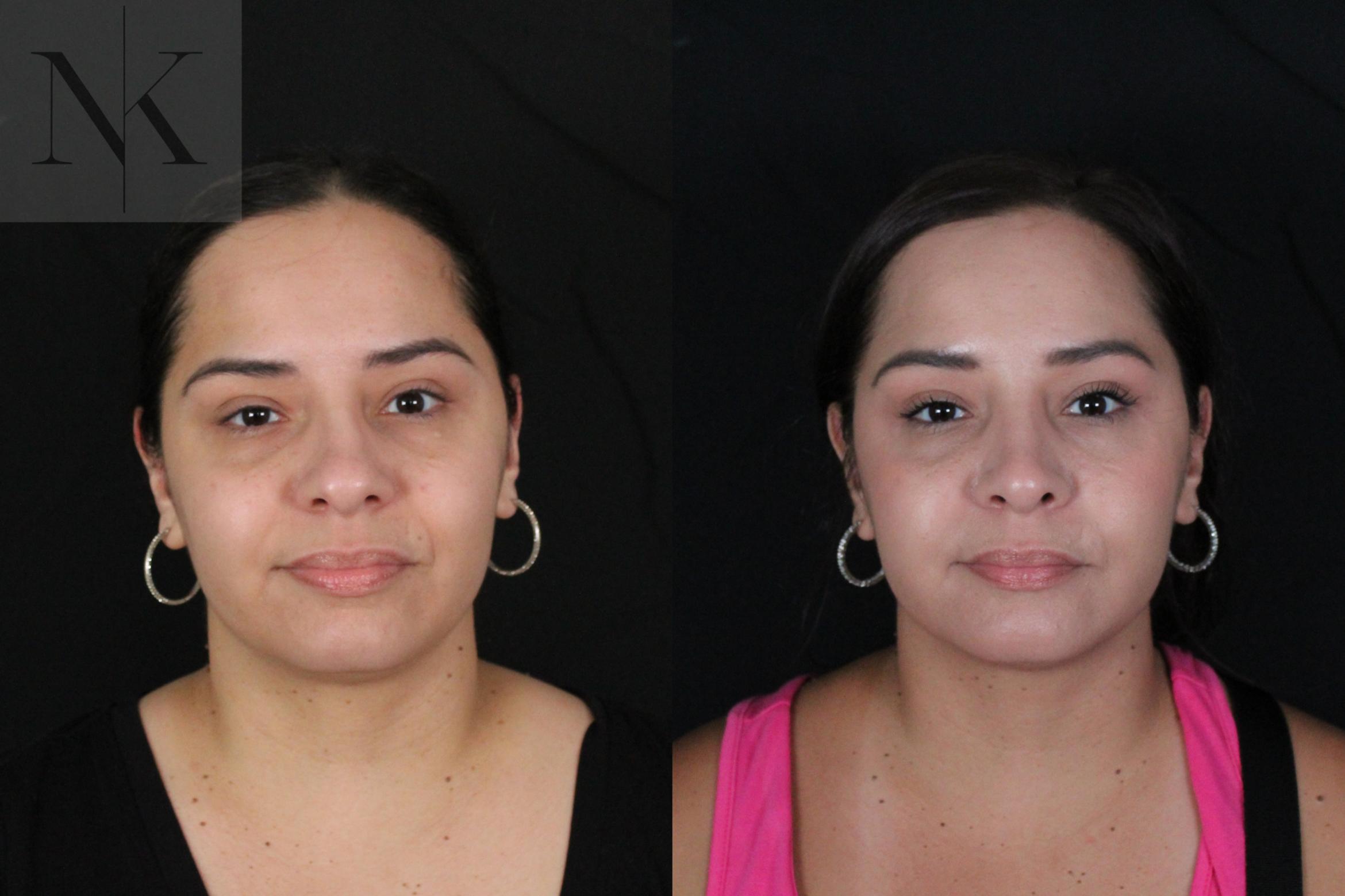 Before & After Rhinoplasty Case 210 Front View in Wethersfield, Hartford, Nebraska