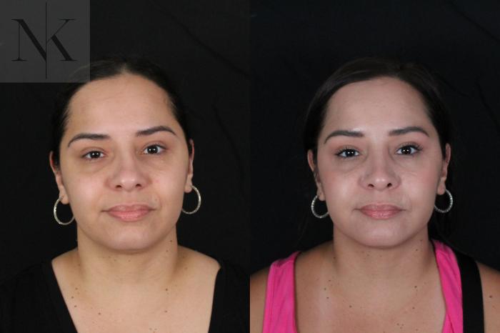 Before & After Rhinoplasty Case 210 Front View in Wethersfield, Hartford, Nebraska