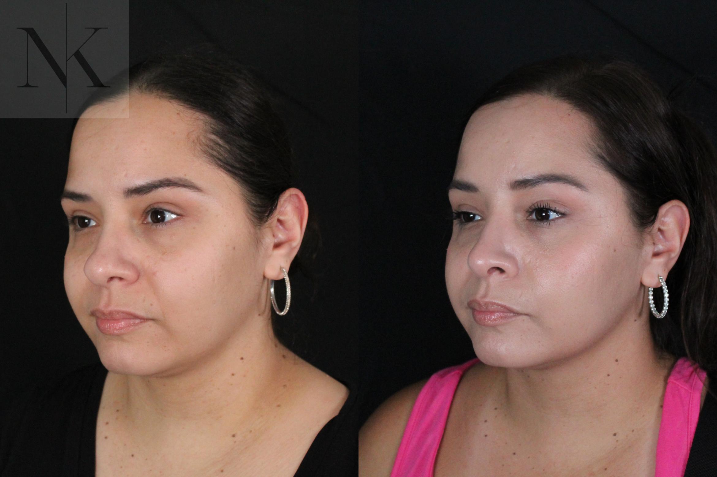 Before & After Rhinoplasty Case 210 Left Oblique View in Wethersfield, Hartford, Nebraska