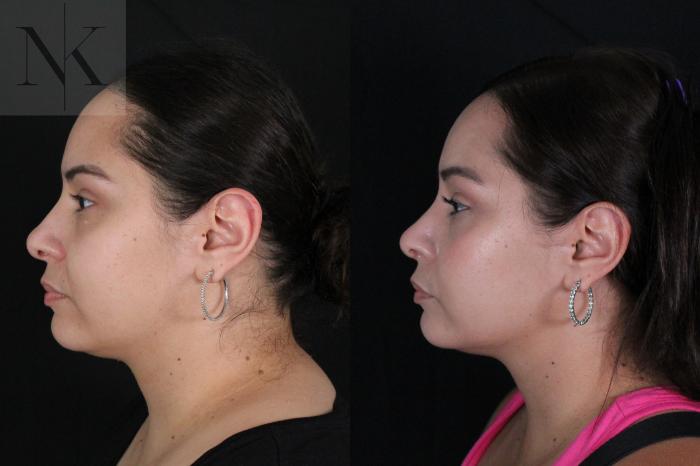 Before & After Rhinoplasty Case 210 Left Side View in Wethersfield, Hartford, Nebraska