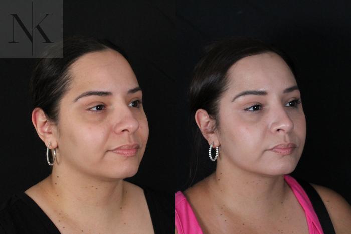 Before & After Rhinoplasty Case 210 Right Oblique View in Wethersfield, Hartford, Nebraska