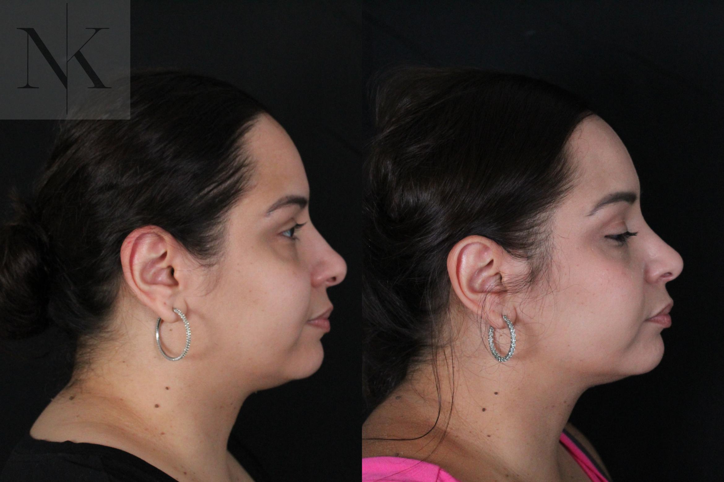 Before & After Rhinoplasty Case 210 Right Side View in Wethersfield, Hartford, Nebraska