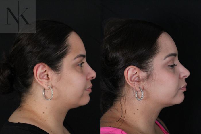 Before & After Rhinoplasty Case 210 Right Side View in Wethersfield, Hartford, Nebraska