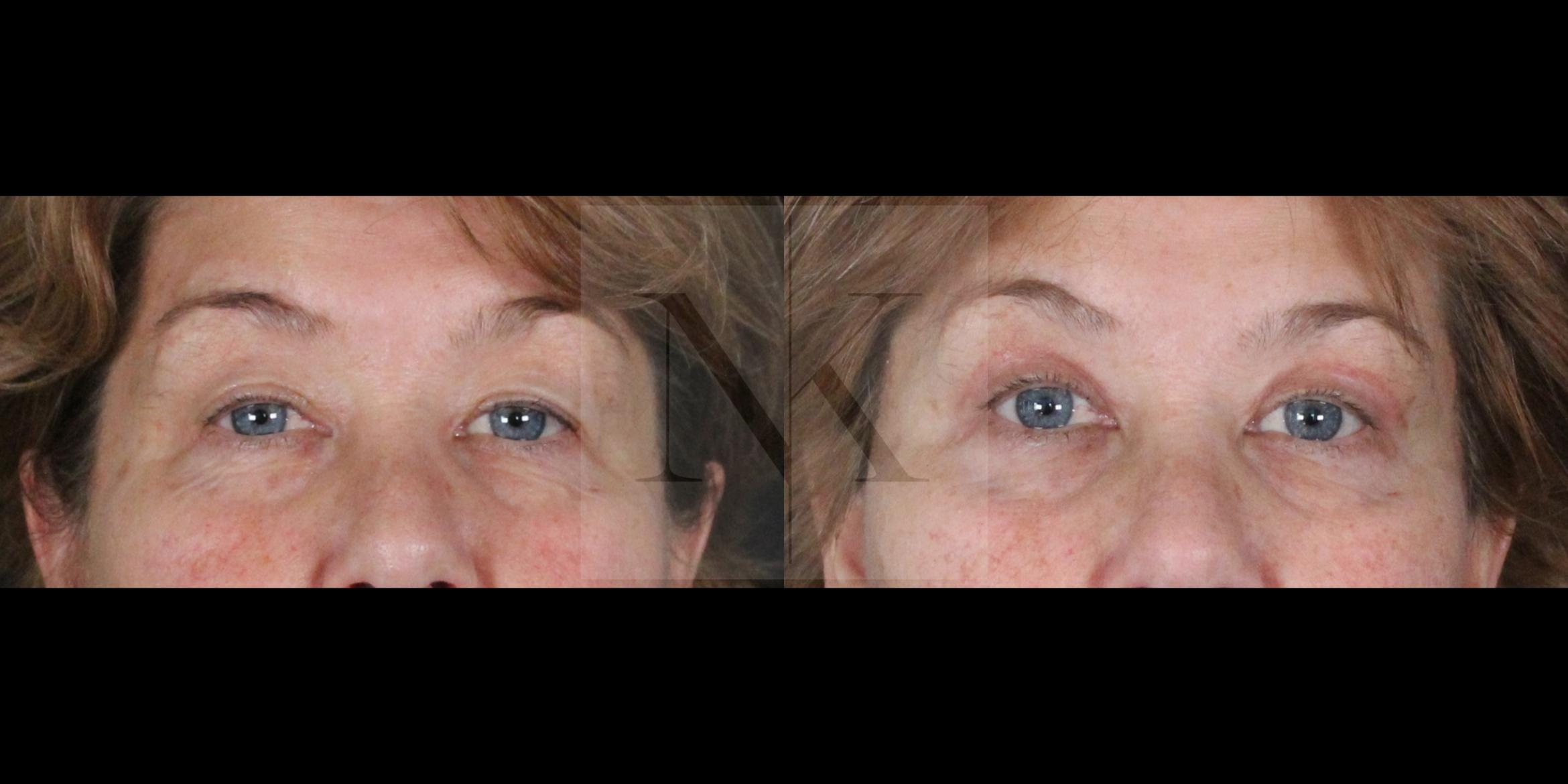 Before & After Upper Blepharoplasty Case 154 Front View in Wethersfield, Hartford, Nebraska