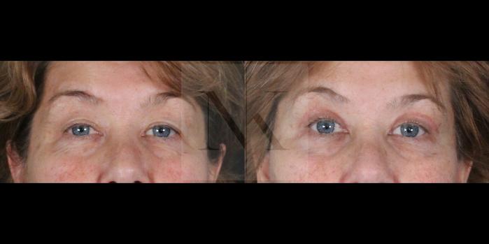 Before & After Upper Blepharoplasty Case 154 Front View in Wethersfield, Hartford, Nebraska