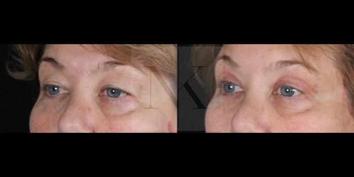 Before & After Upper Blepharoplasty Case 154 Left Oblique View in Wethersfield, Hartford, Nebraska