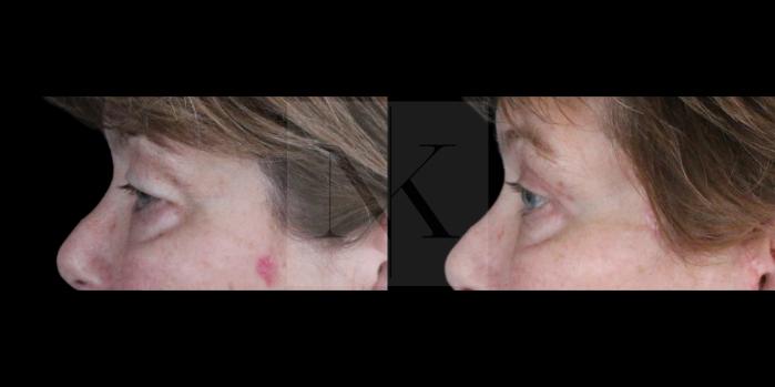 Before & After Upper Blepharoplasty Case 154 Left Side View in Wethersfield, Hartford, Nebraska