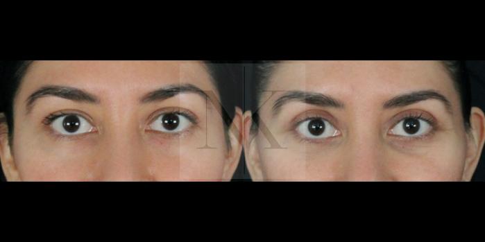 Before & After Upper Blepharoplasty Case 156 Front View in Wethersfield, Hartford, Nebraska