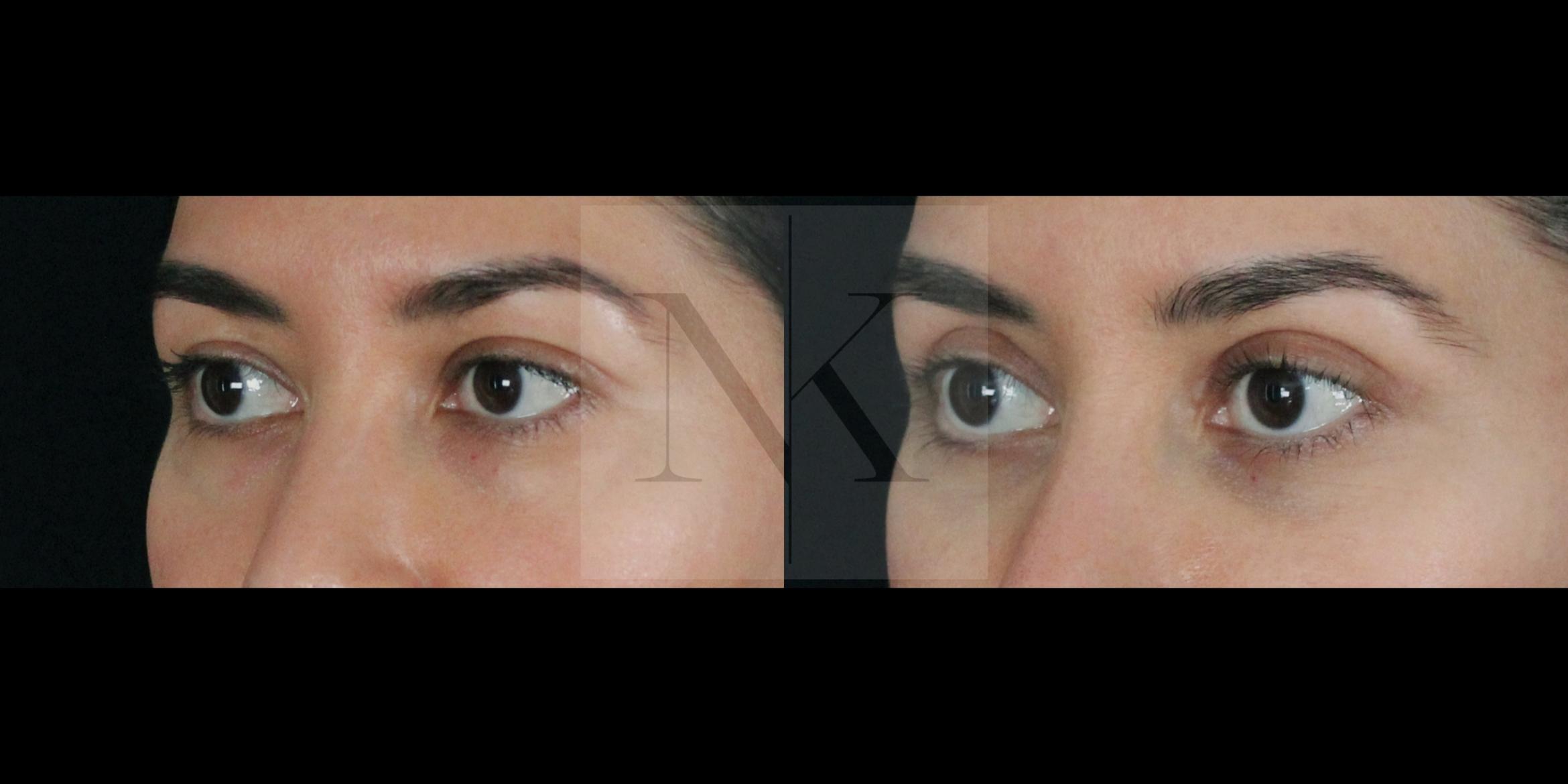 Before & After Upper Blepharoplasty Case 156 Left Oblique View in Wethersfield, Hartford, Nebraska