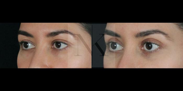 Before & After Upper Blepharoplasty Case 156 Left Oblique View in Wethersfield, Hartford, Nebraska