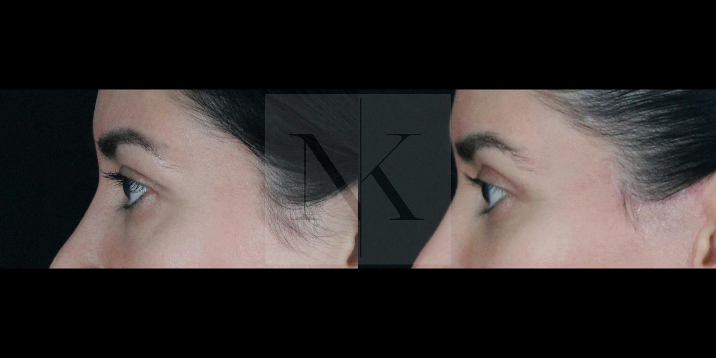 Before & After Upper Blepharoplasty Case 156 Left Side View in Wethersfield, Hartford, Nebraska