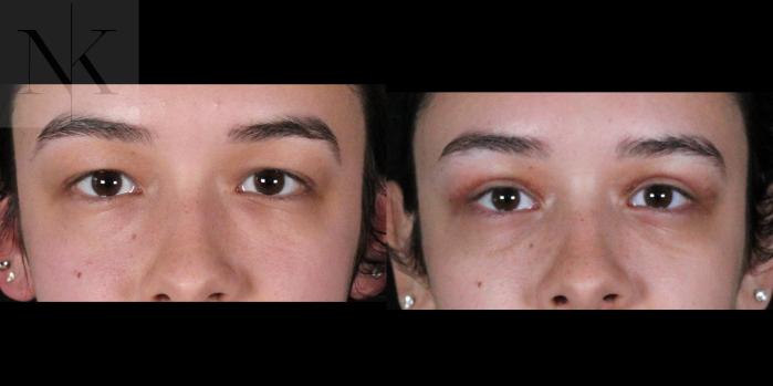 Before & After Lower Blepharoplasty Case 176 Front View in Wethersfield, Hartford, Nebraska