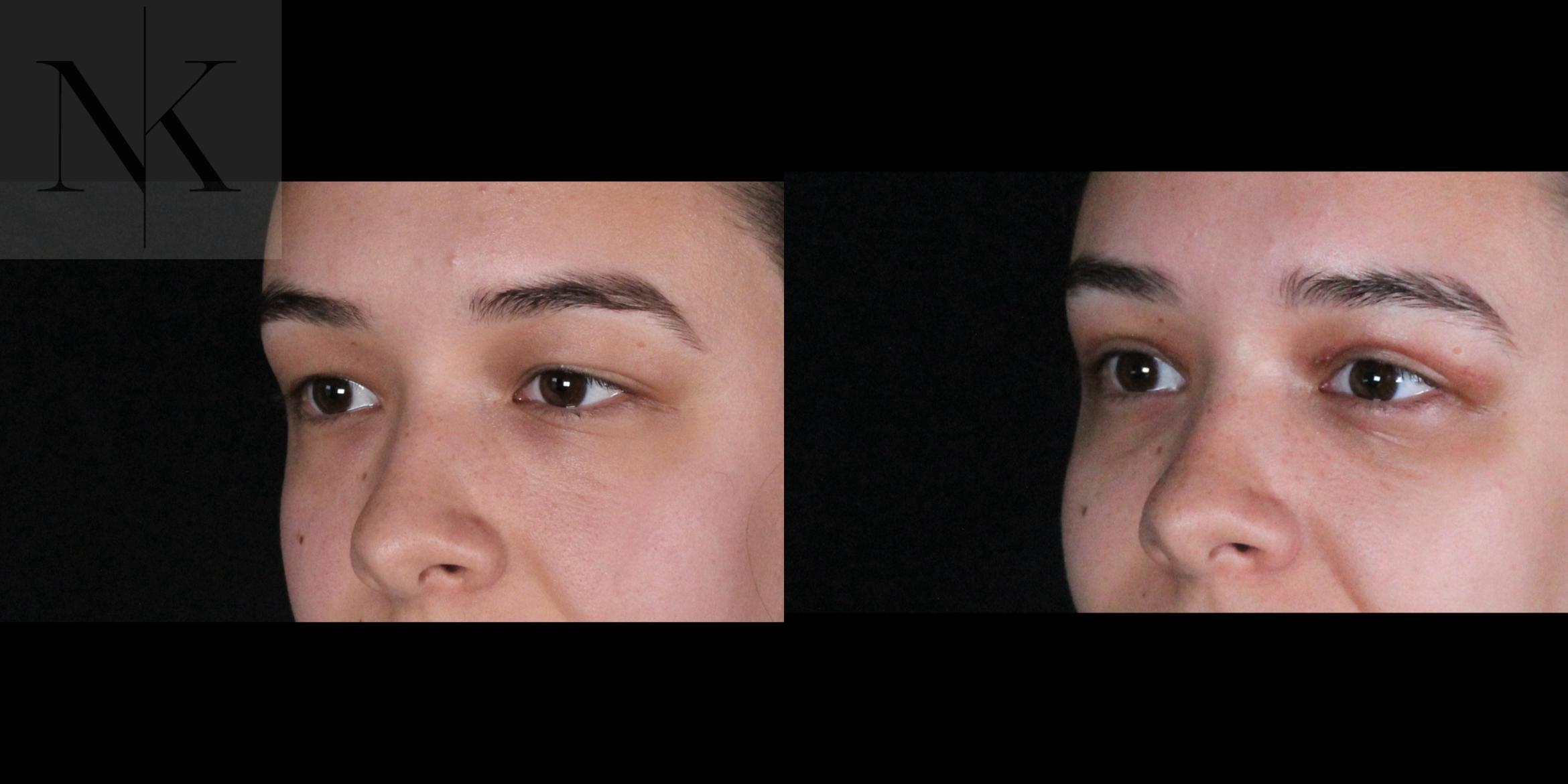 Before & After Lower Blepharoplasty Case 176 Left Oblique View in Wethersfield, Hartford, Nebraska