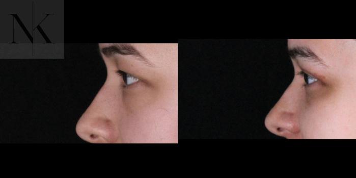 Before & After Lower Blepharoplasty Case 176 Left Side View in Wethersfield, Hartford, Nebraska