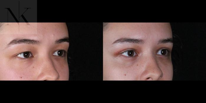 Before & After Lower Blepharoplasty Case 176 Right Oblique View in Wethersfield, Hartford, Nebraska