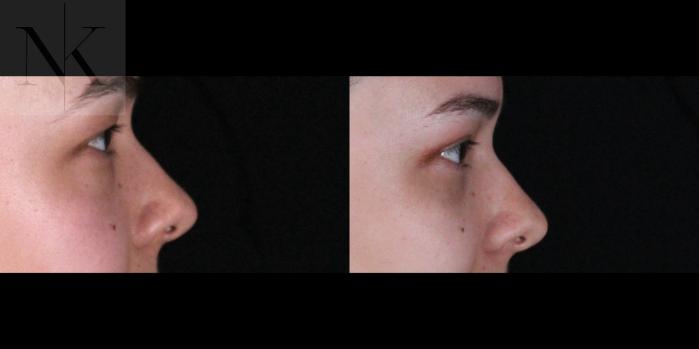 Before & After Lower Blepharoplasty Case 176 Right Side View in Wethersfield, Hartford, Nebraska