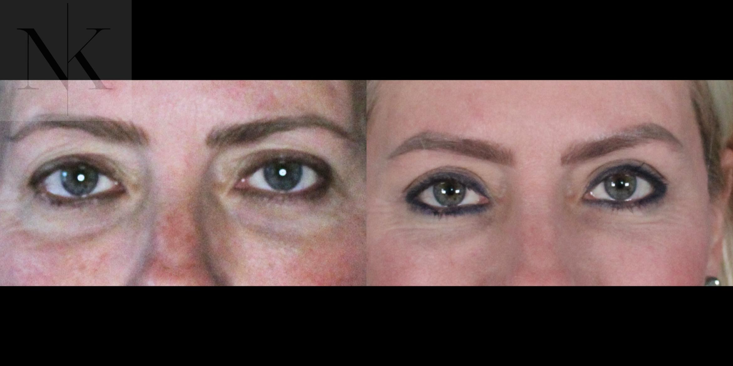 Before & After Lower Blepharoplasty Case 177 Front View in Wethersfield, Hartford, Nebraska
