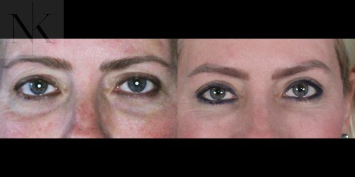 Before & After Lower Blepharoplasty Case 177 Front View in Wethersfield, Hartford, Nebraska