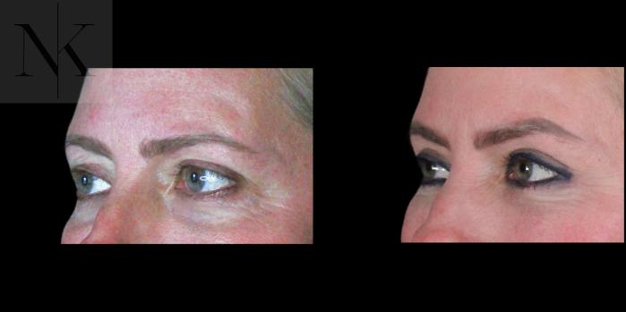 Before & After Lower Blepharoplasty Case 177 Left Oblique View in Wethersfield, Hartford, Nebraska