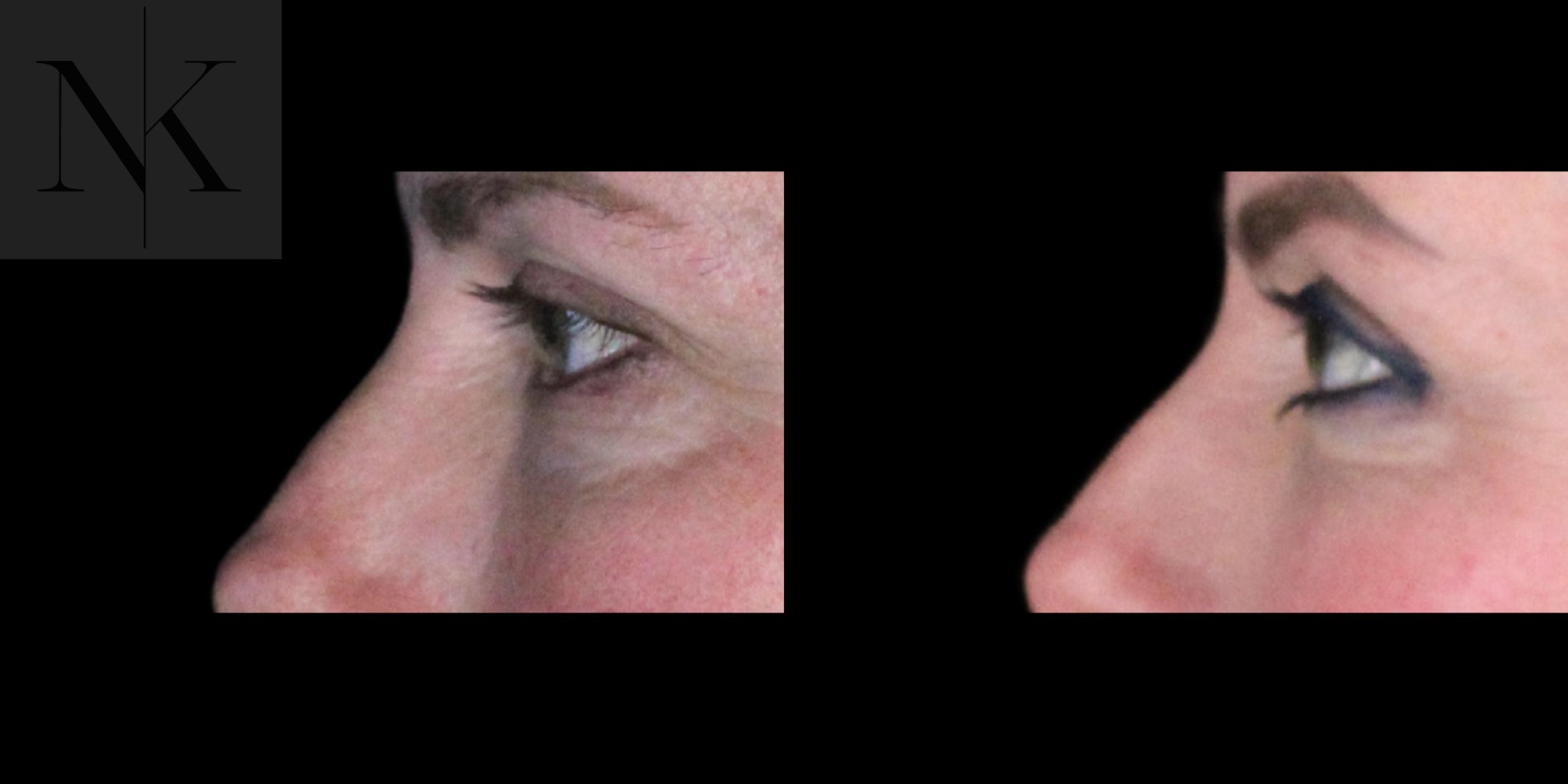 Before & After Lower Blepharoplasty Case 177 Left Side View in Wethersfield, Hartford, Nebraska