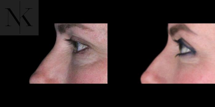 Before & After Lower Blepharoplasty Case 177 Left Side View in Wethersfield, Hartford, Nebraska