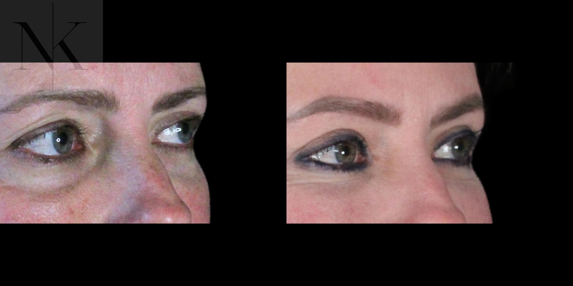 Before & After Lower Blepharoplasty Case 177 Right Oblique View in Wethersfield, Hartford, Nebraska