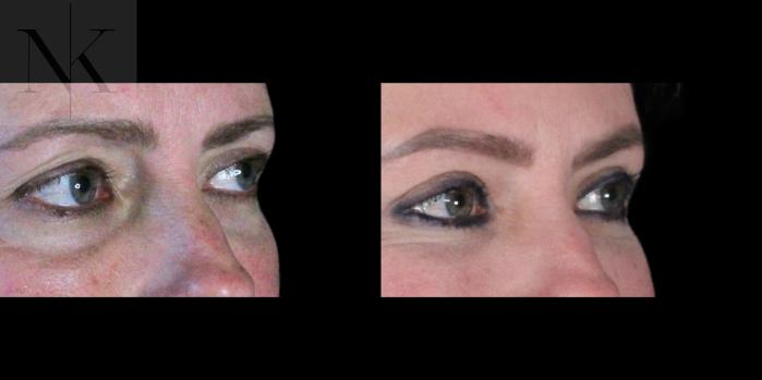 Before & After Lower Blepharoplasty Case 177 Right Oblique View in Wethersfield, Hartford, Nebraska