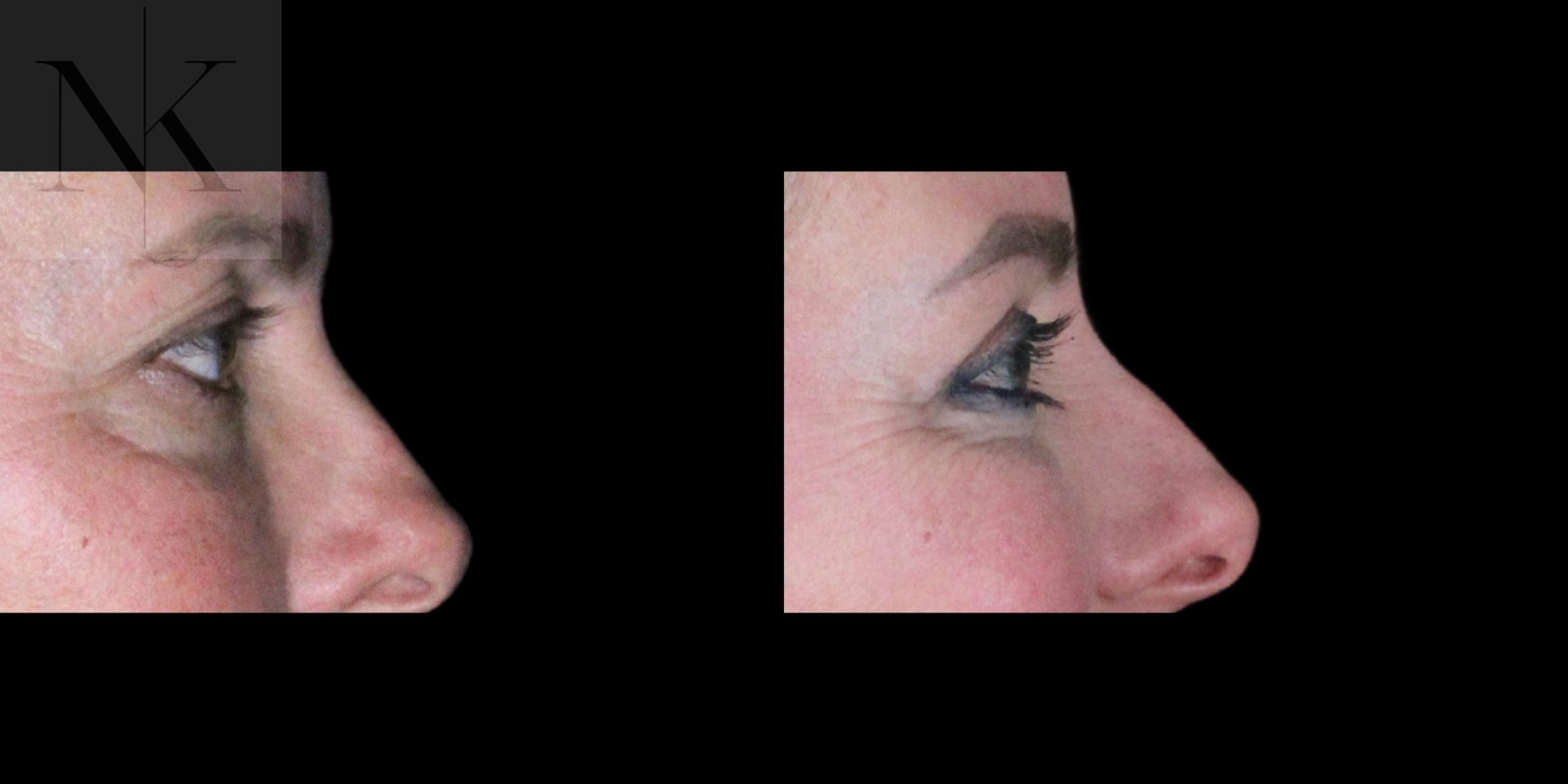 Before & After Lower Blepharoplasty Case 177 Right Side View in Wethersfield, Hartford, Nebraska