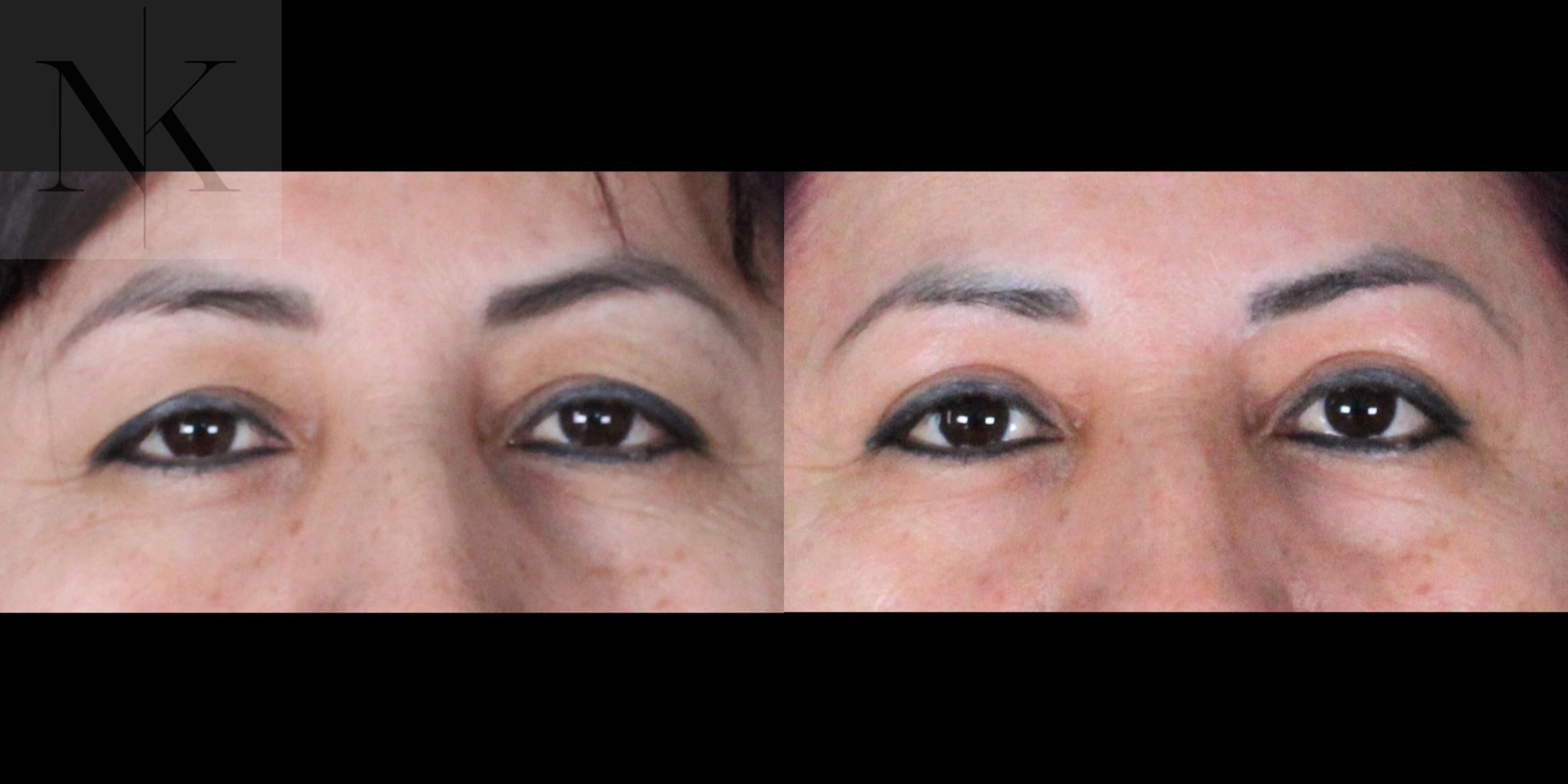 Before & After Upper Blepharoplasty Case 182 Front View in Wethersfield, Hartford, Nebraska