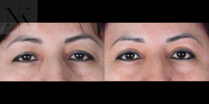 Before & After Upper Blepharoplasty Case 182 Front View in Wethersfield, Hartford, Nebraska
