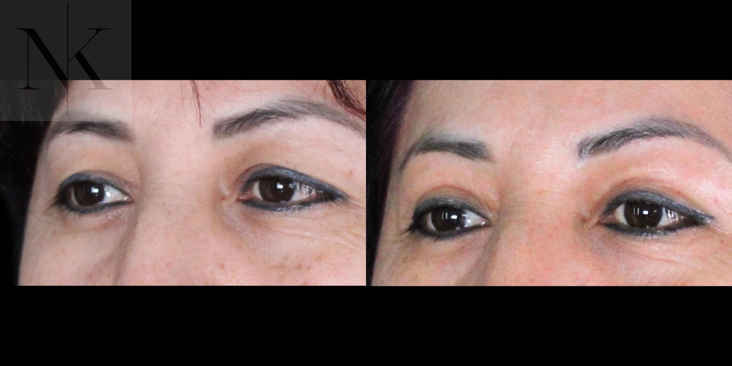 Before & After Upper Blepharoplasty Case 182 Left Oblique View in Wethersfield, Hartford, Nebraska