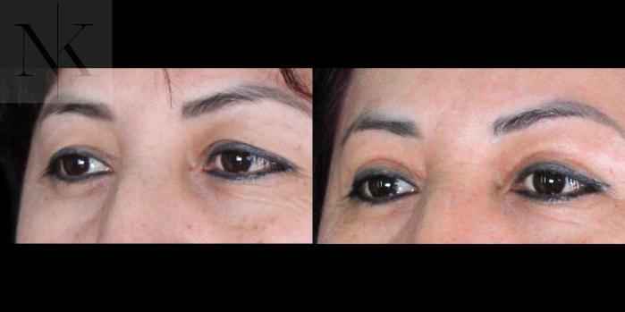Before & After Upper Blepharoplasty Case 182 Left Oblique View in Wethersfield, Hartford, Nebraska