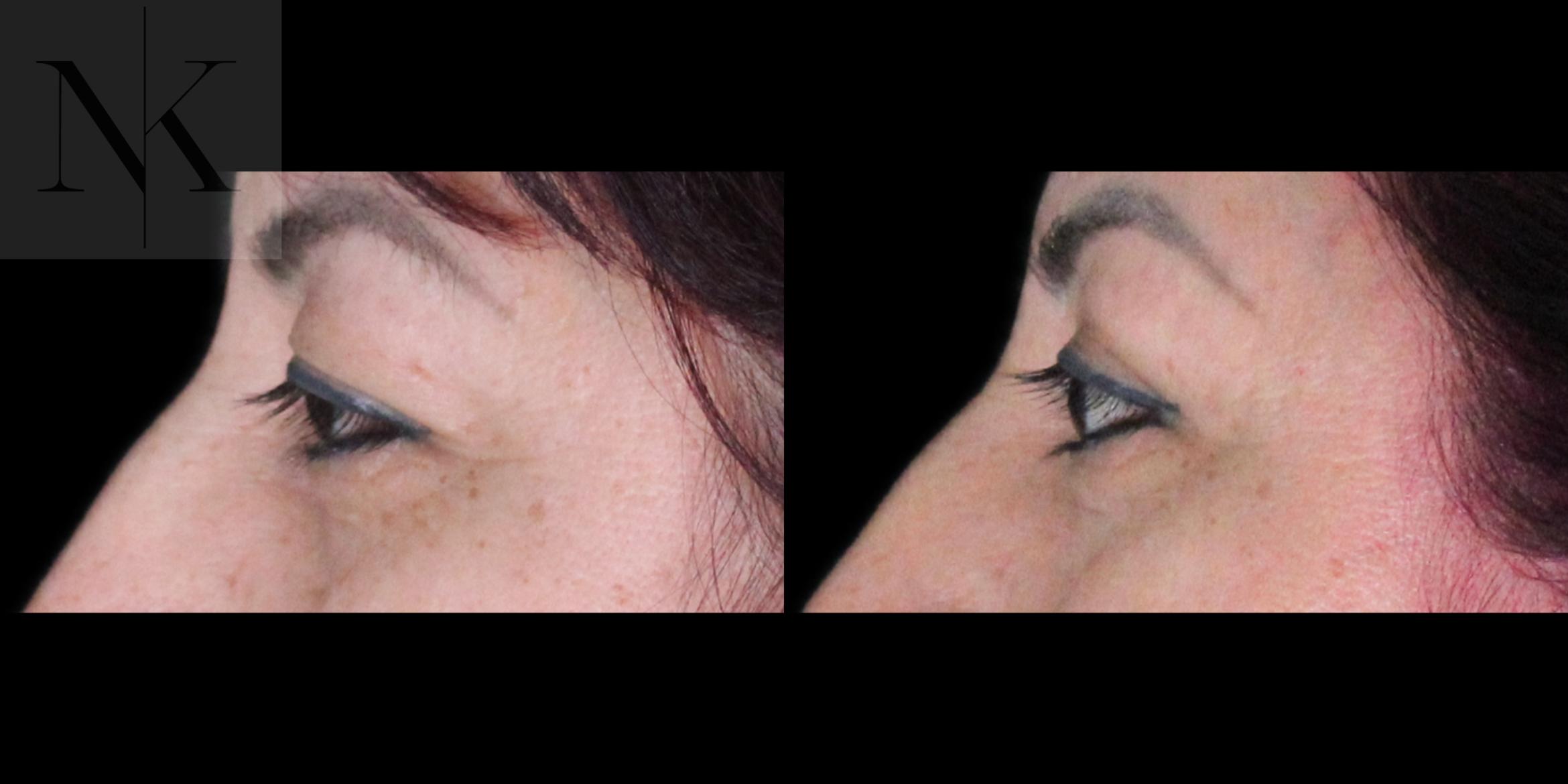 Before & After Upper Blepharoplasty Case 182 Left Side View in Wethersfield, Hartford, Nebraska
