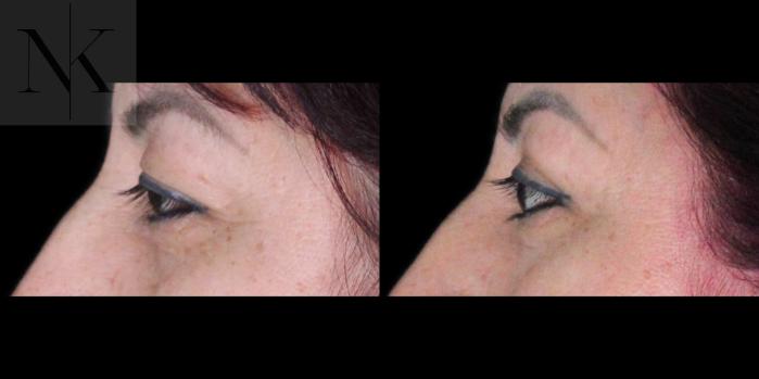 Before & After Upper Blepharoplasty Case 182 Left Side View in Wethersfield, Hartford, Nebraska